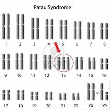 Cariótipo da Síndrome de Patau