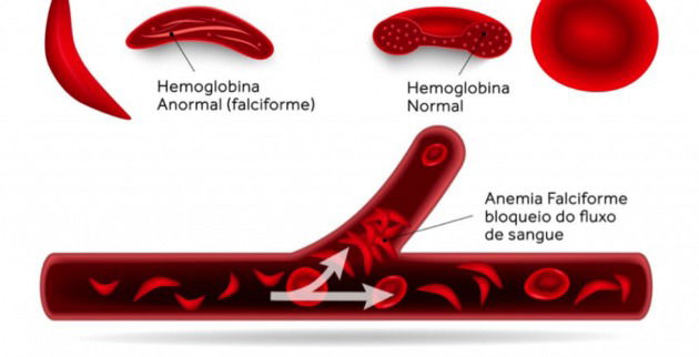 Anemia O Que é Sintomas E Tratamento Toda Matéria