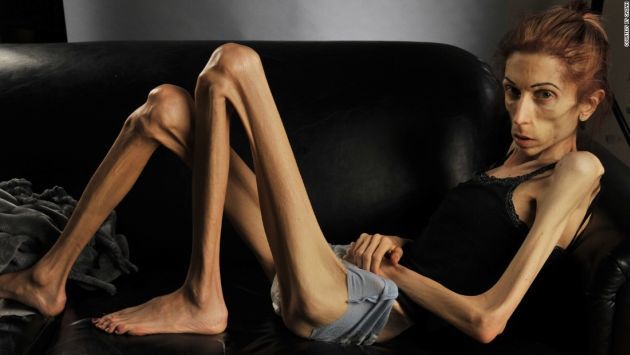 Pessoa com anorexia