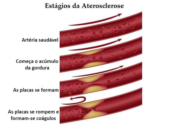 Aterosklerosens stadier