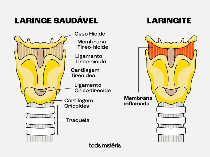 Laringe