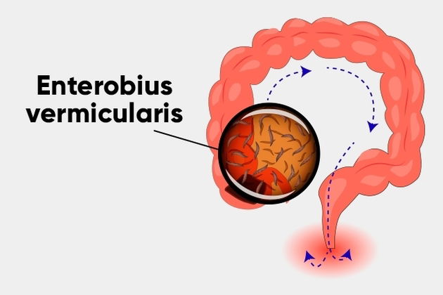 Que es oxiuriasis - lombrices intestinales. Oxiuros oxiuros sintomas