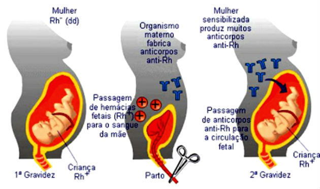 Eritroblastose fetal