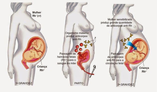 eritoblastose fetal