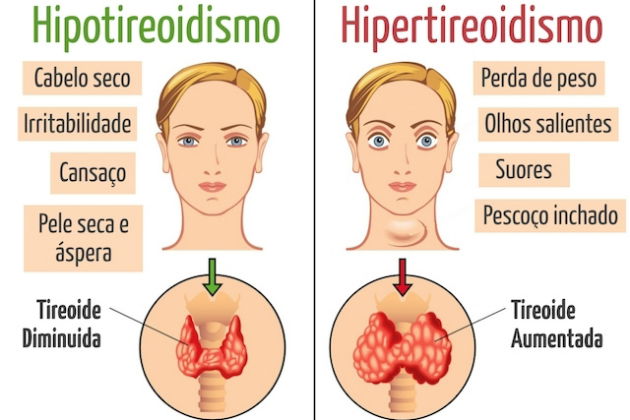 Resultado de imagem para hipertireoidismo