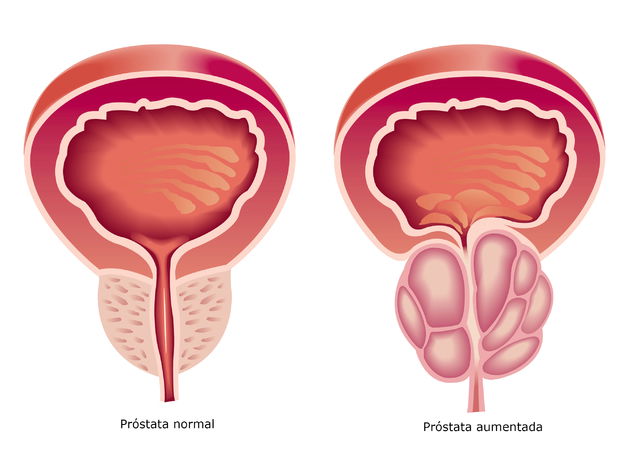 prostata