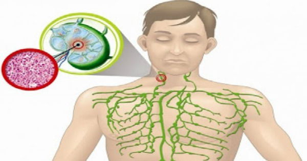 Linfoma: O Que é, Sintomas E Tipos - Toda Matéria