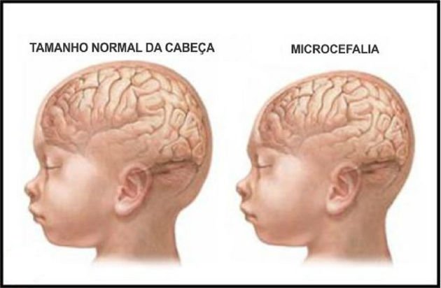 Microcefalia Toda Matéria 1541
