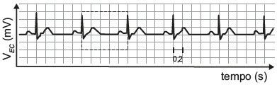 Imagem de ondas em eletrocardiograma.