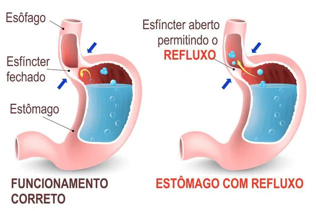 Esôfago O Que é Anatomia E Doenças Toda Matéria