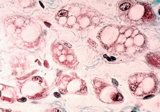 O tecido adiposo multilocular possui várias gotas de gordura envoltas por citoplasma, com isso a célula tem aspecto esponjoso.
